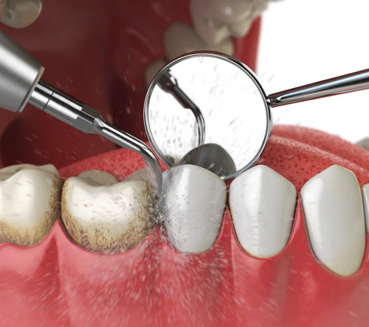 Dental Cleaning