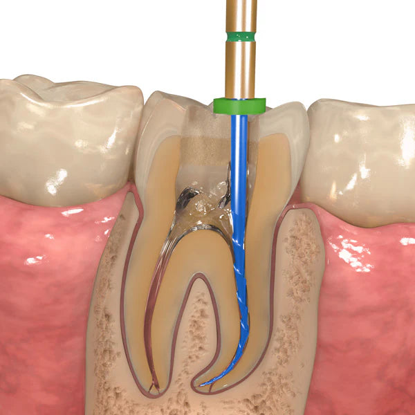 Endodontic Therapy