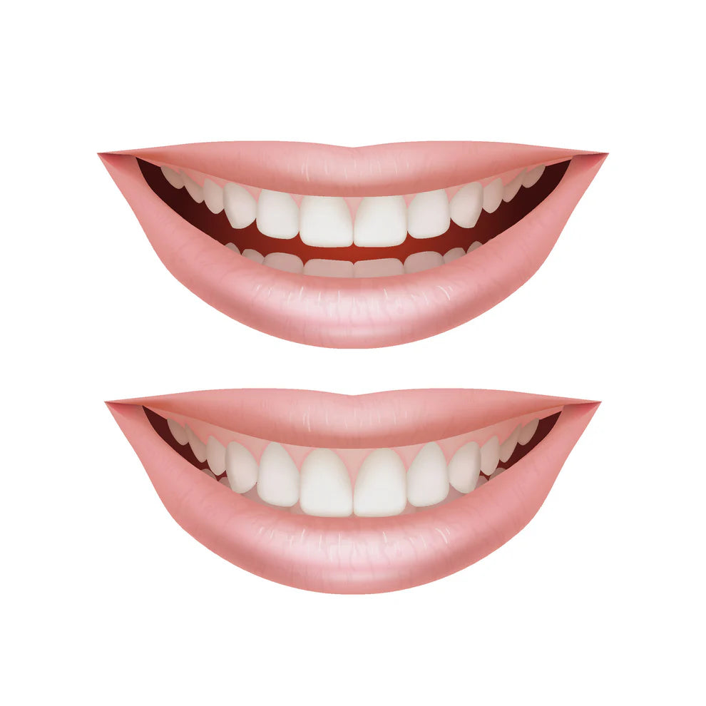 Full Arch Mouth Rehabilitation