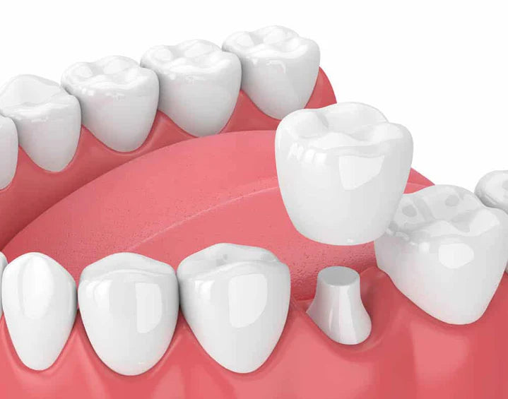 Dental Crown