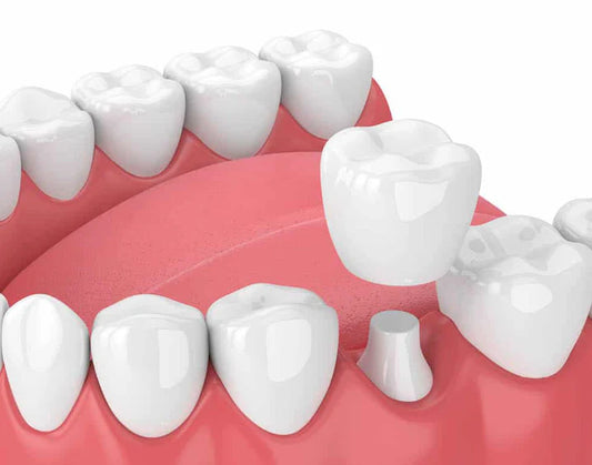 Dental Crown
