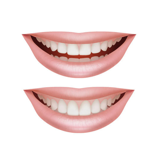 Full Arch Mouth Rehabilitation