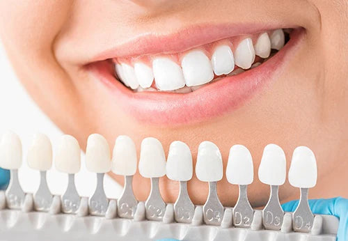 Veneers